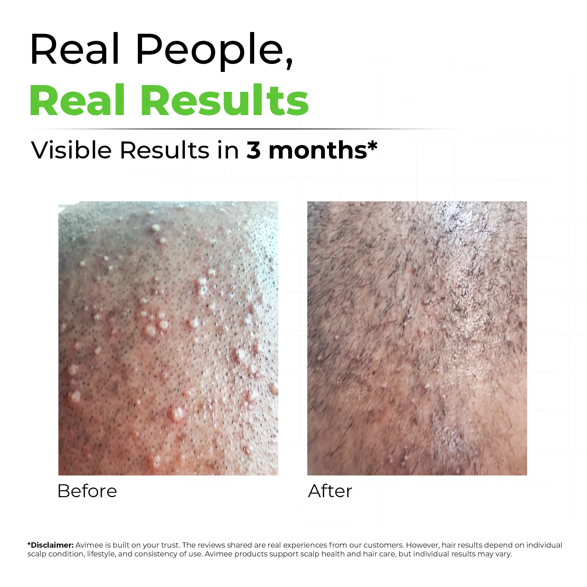 Instant Water Softener for Hair Loss Due to Hard Water - Image 6