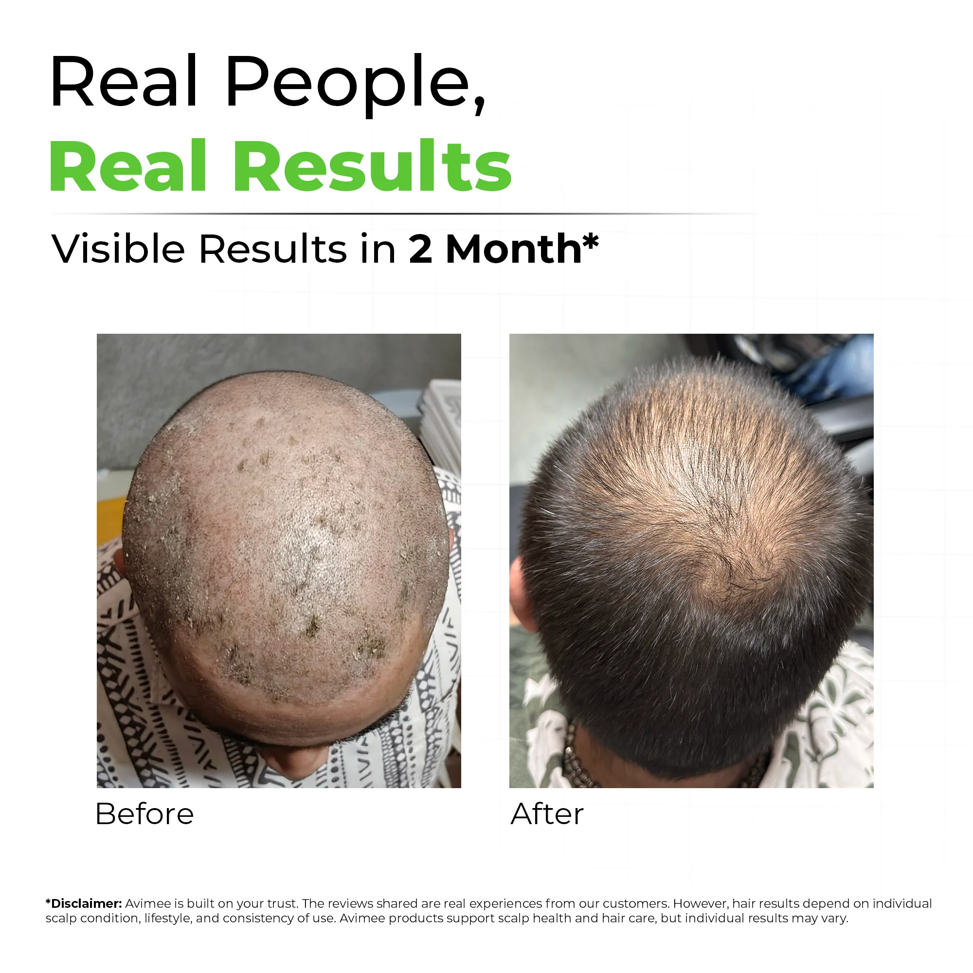 Scalptone Dandruff Serum - Image 6