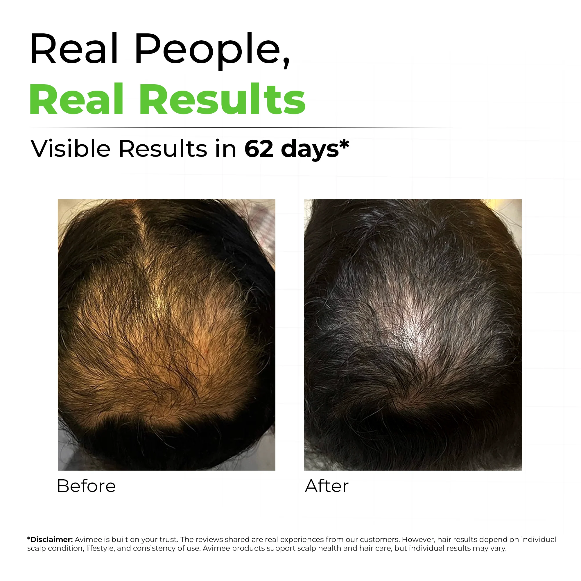 Hair Growth Kit for Stage 3 Hair Loss - Image 4