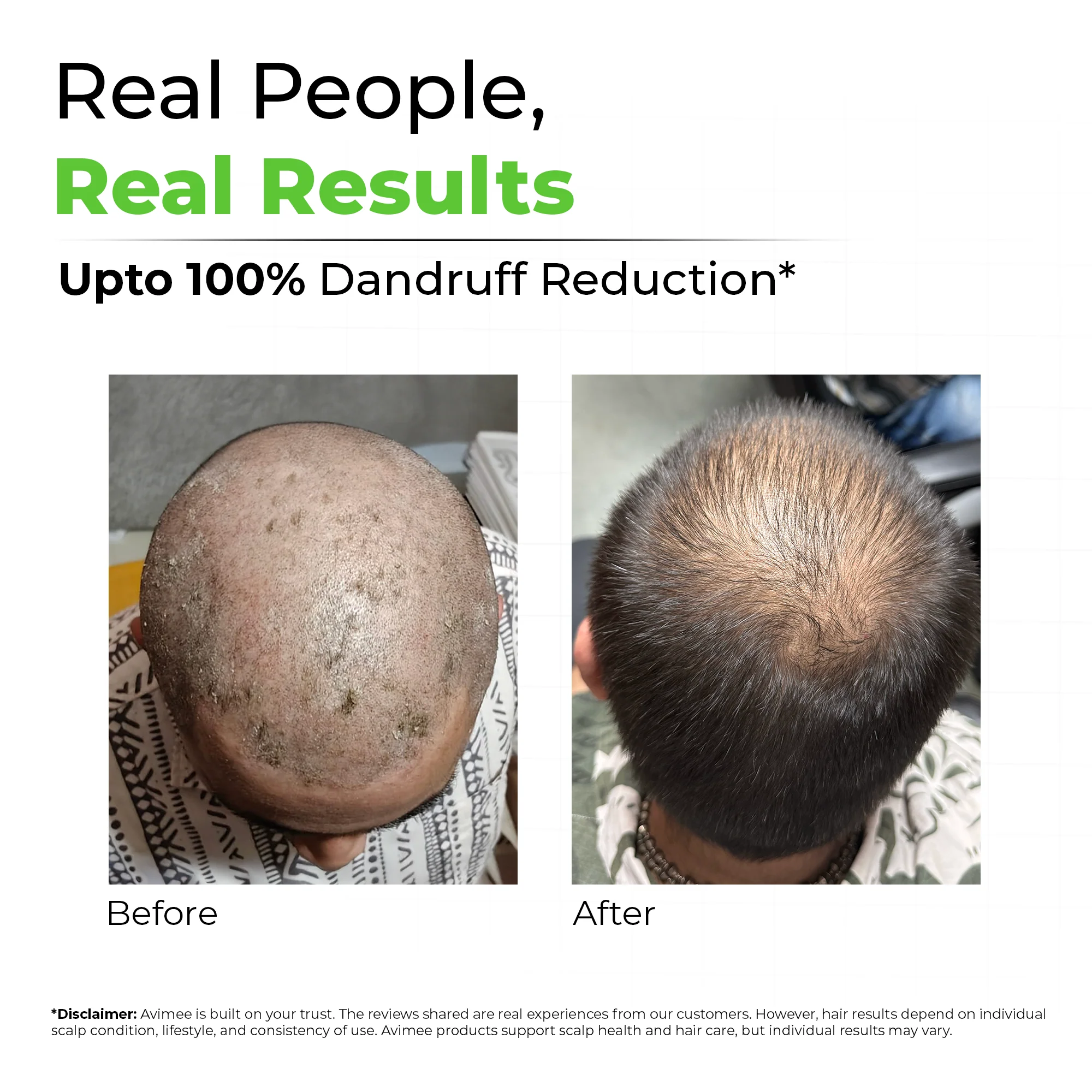 Shakuntala Hair Cleanser for Dandruff - Image 6